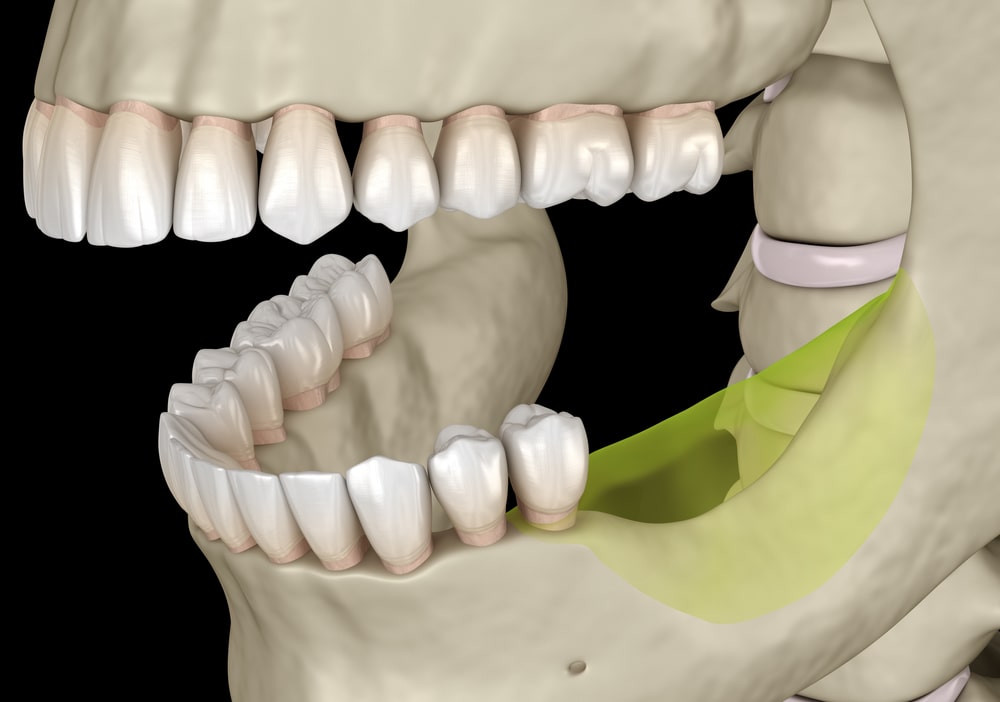 Un exemple de perte osseuse où les molaires sont manquantes