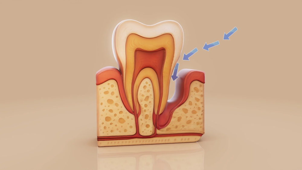 Illustration 3D des effets de la parodontite sur une dent et les tissus qui la soutiennent
