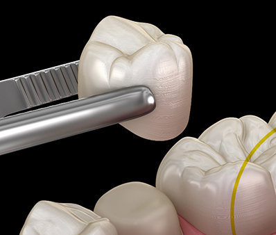 Couronne CEREC