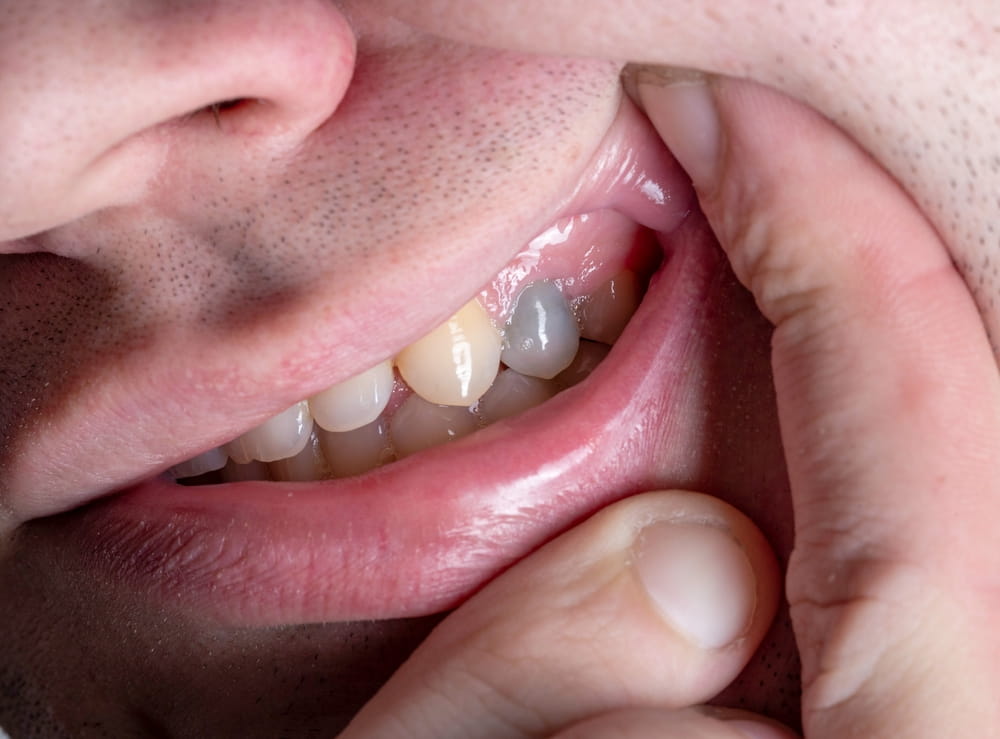 Un homme présente une dent qui noircit au niveau des dents supérieures à gauche